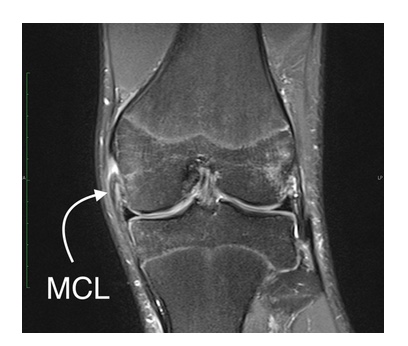 medial collateral ligament mri