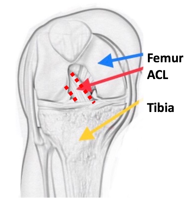 Everything You Need to Know About Anterior Cruciate Ligament (ACL