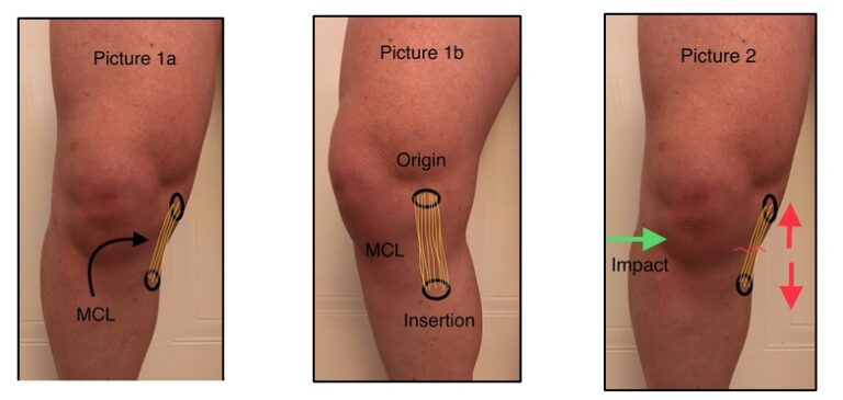 Acl And Mcl Diagram